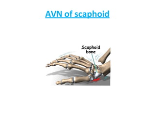 AVN of scaphoid
 