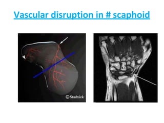 Vascular disruption in # scaphoid
 