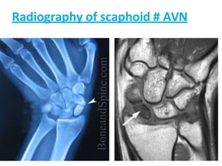 Radiography of scaphoid # AVN
 