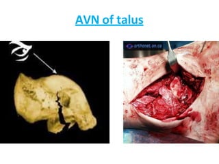 AVN of talus
 