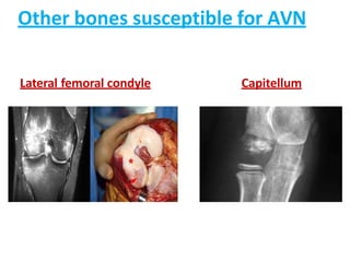 Other bones susceptible for AVN
Lateral femoral condyle Capitellum
 
