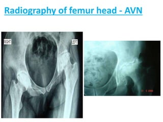 Avascular necrosis ug class | PPTX