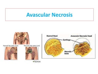 Avascular Necrosis
 