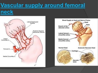 Vascular supply around femoral
neck
 