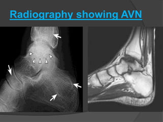 Radiography showing AVN
 
