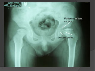 Luscent areas
Flattening of joint
surface
 
