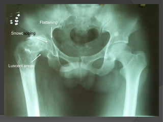 Snowcapping
Luscent areas
Flattening
 
