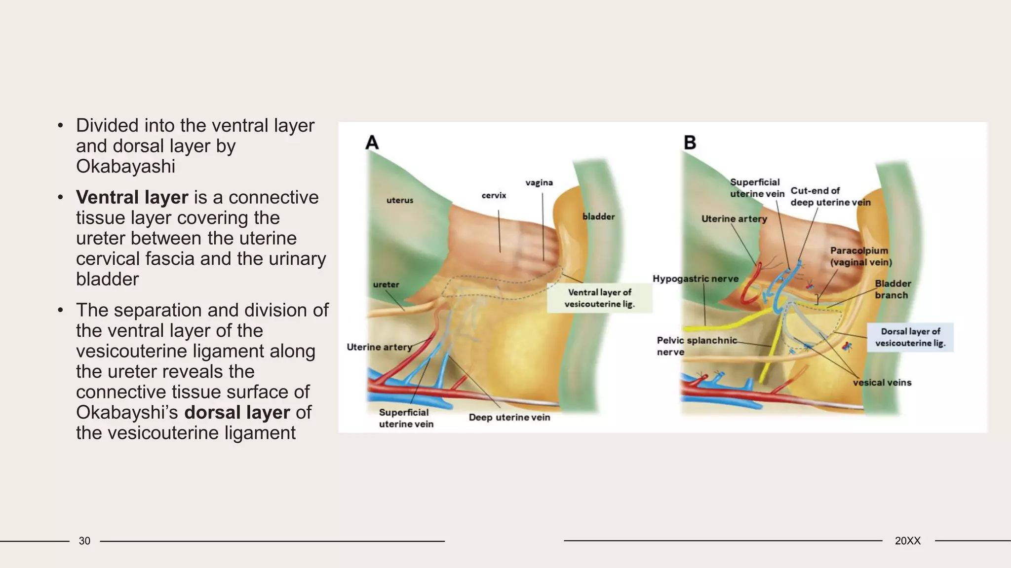Avascular spaces in radical hysterectomy.pptx