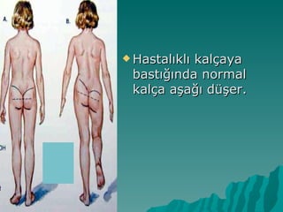  Hastalıklı
           kalçaya
 bastığında normal
 kalça aşağı düşer.
 