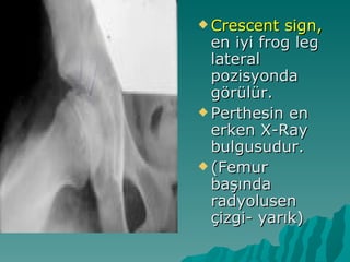  Crescent  sign,
  en iyi frog leg
  lateral
  pozisyonda
  görülür.
 Perthesin en
  erken X-Ray
  bulgusudur.
 (Femur
  başında
  radyolusen
  çizgi- yarık)
 
