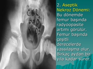  2.Aseptik
 Nekroz Dönemi:
 Bu dönemde
 femur başında
 radyoopasite
 artımı görülür.
 Femur başında
 çeşitli
 derecelerde
 yassılaşma olur.
 Birkaç aydan bir
 yıla kadar sürer.
 
