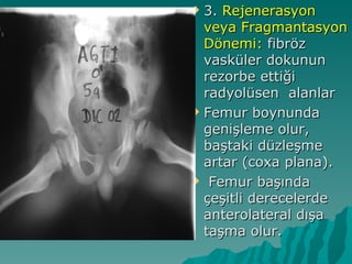  3. Rejenerasyon
  veya Fragmantasyon
  Dönemi: fibröz
  vasküler dokunun
  rezorbe ettiği
  radyolüsen alanlar
 Femur boynunda
  genişleme olur,
  baştaki düzleşme
  artar (coxa plana).
 Femur başında
  çeşitli derecelerde
  anterolateral dışa
  taşma olur.
 