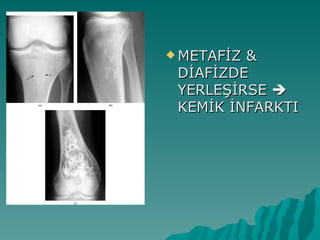  METAFİZ&
 DİAFİZDE
 YERLEŞİRSE 
 KEMİK İNFARKTI
 