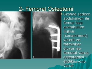 2- Femoral Osteotomi
                  Grafide sadece
                   abduksiyon ile
                   femur başı
                   asetabulum
                   ilişkisi
                   (conainment)
                   yeterli ve
                   tatminkar
                   oluyor ise
                   femoral varus
                   osteotomisi
                   endikasyonu
                   vardır
 