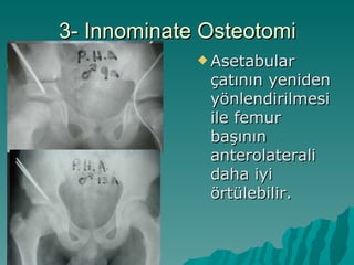 3- Innominate Osteotomi
              Asetabular
              çatının yeniden
              yönlendirilmesi
              ile femur
              başının
              anterolaterali
              daha iyi
              örtülebilir.
 