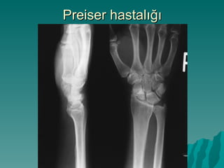 Preiser hastalığı
 