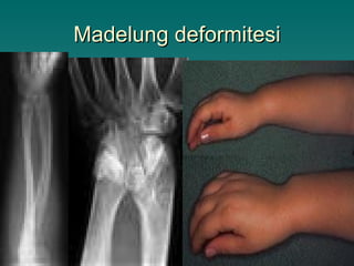 Madelung deformitesi
 