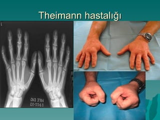 Theimann hastalığı
 