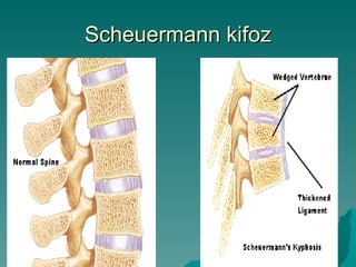 Scheuermann kifoz
 