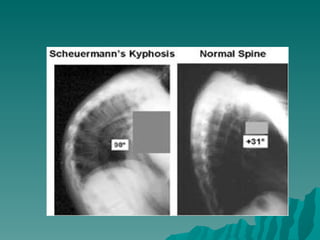 Avasküler nekrozlar (fazlası için www.tipfakultesi.org )