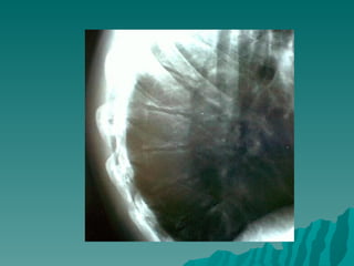 Avasküler nekrozlar (fazlası için www.tipfakultesi.org )