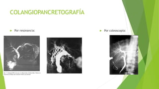 COLANGIOPANCRETOGRAFÍA
 Por resonancia:  Por coleoscopía:
 