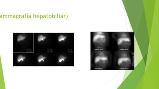 ammagrafía hepatobiliar)
 