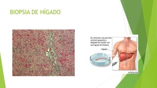 BIOPSIA DE HÍGADO
 