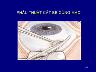 31
PHAÃU THUAÄT CAÉT BEØ CUÛNG MAÏC
 