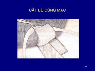 35
CAÉT BEØ CUÛNG MAÏC
 