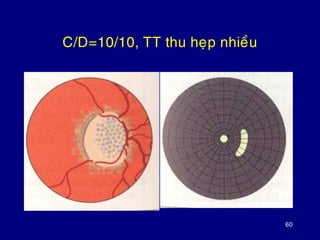 60
C/D=10/10, TT thu heïp nhieàu
 