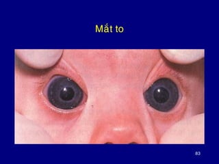 83
Maét to
 