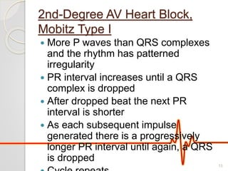 2nd-Degree AV Heart Block,
Mobitz Type I
 More P waves than QRS complexes
and the rhythm has patterned
irregularity
 PR interval increases until a QRS
complex is dropped
 After dropped beat the next PR
interval is shorter
 As each subsequent impulse
generated there is a progressively
longer PR interval until again, a QRS
is dropped
13
 