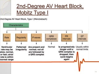 2nd-Degree AV Heart Block,
Mobitz Type I
14
 