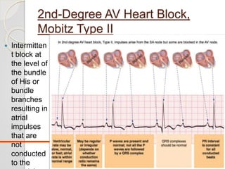 2nd-Degree AV Heart Block,
Mobitz Type II
 Intermitten
t block at
the level of
the bundle
of His or
bundle
branches
resulting in
atrial
impulses
that are
not
conducted
to the 16
 