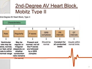 2nd-Degree AV Heart Block,
Mobitz Type II
17
 