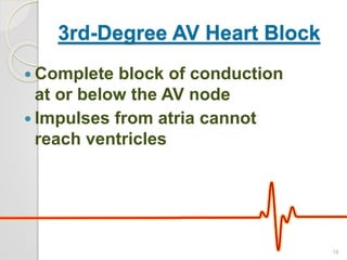 3rd-Degree AV Heart Block
 Complete block of conduction
at or below the AV node
 Impulses from atria cannot
reach ventricles
18
 