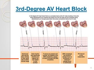 3rd-Degree AV Heart Block
19
 