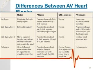 Differences Between AV Heart
Blocks
21
 