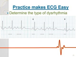 Practice makes ECG Easy
 Determine the type of dysrhythmia
23
 