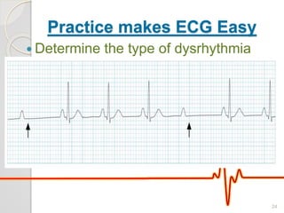 Practice makes ECG Easy
 Determine the type of dysrhythmia
24
 