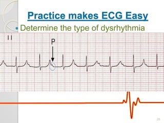 Practice makes ECG Easy
 Determine the type of dysrhythmia
25
 
