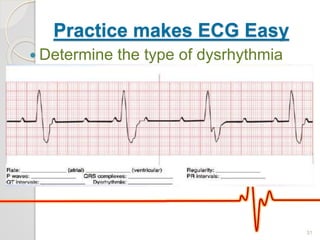 Practice makes ECG Easy
 Determine the type of dysrhythmia
31
 