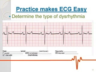 Practice makes ECG Easy
 Determine the type of dysrhythmia
33
 