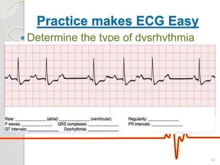 Practice makes ECG Easy
 Determine the type of dysrhythmia
34
 
