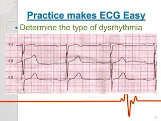 Practice makes ECG Easy
 Determine the type of dysrhythmia
36
 