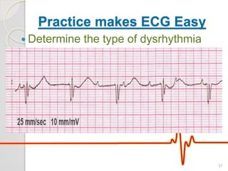 Practice makes ECG Easy
 Determine the type of dysrhythmia
37
 