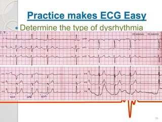 Practice makes ECG Easy
 Determine the type of dysrhythmia
39
 