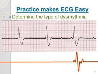 Practice makes ECG Easy
 Determine the type of dysrhythmia
41
 