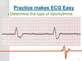 Practice makes ECG Easy
 Determine the type of dysrhythmia
42
 
